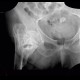 Hip fracture, pertrochanteric fracture of femur, healed in dislocation: X-ray - Plain radiograph